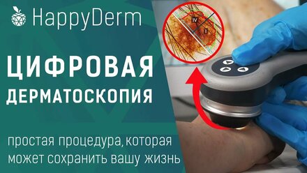 Цифровая Дерматоскопия новообразований. Как снизить риск развития рака кожи. HappyDerm