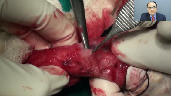 Penectomy anime