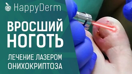 КАК УДАЛИТЬ ВРОСШИЙ НОГОТЬ БЕЗ БОЛИ, ЛЕЧЕНИЕ ОНИХОКРИПТОЗА ЛАЗЕРОМ