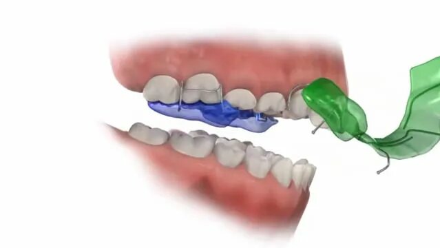 Twin Block | Overbite Correction - Смотреть онлайн в поиске Яндекса по ...