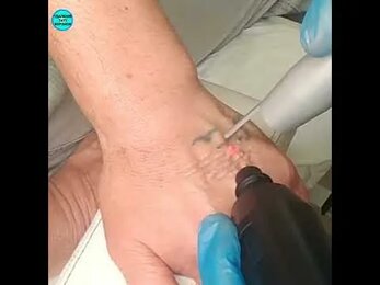 Удаление татуировки на кисти Воронеж