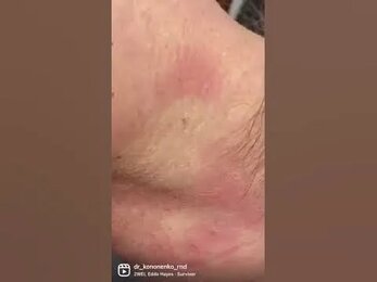Удаление новообразований в клинике Laserplanet.