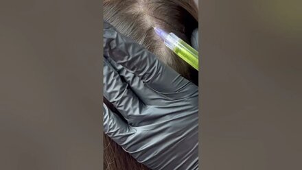 Мезотерапия волосистой части головы #витаминыдляволос #пептиды #выпадениеволос #алопеция #волосы