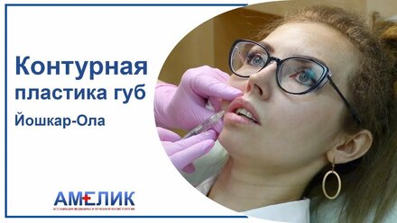 Увеличение губ Йошкар-Ола. Косметолог Йошкар-Ола