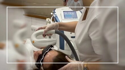 Фототерапия М22 для лечения акне