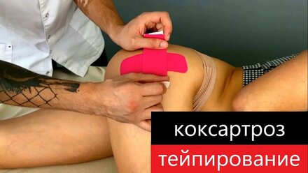 Коксартроз, тейпирование. Противоболевая звезда на тазобедренный сустав