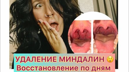 УДАЛЕНИЕ МИНДАЛИН 2024. ОТЗЫВ. ВОССТАНОВЛЕНИЕ ПО ДНЯМ + фото