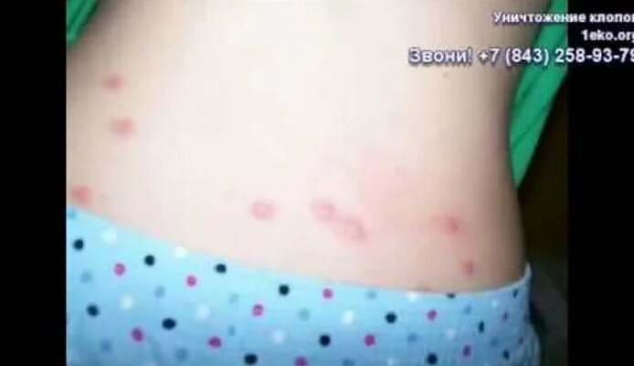 Видео Укусы постельных клопов на людях и детях | OK.RU - Смотреть ...