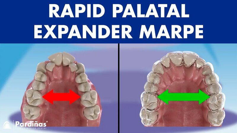 Rapid Palatal expander Marpe - This Orthodontic device can Expand the ...