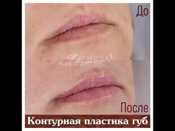 Контурная пластика губ