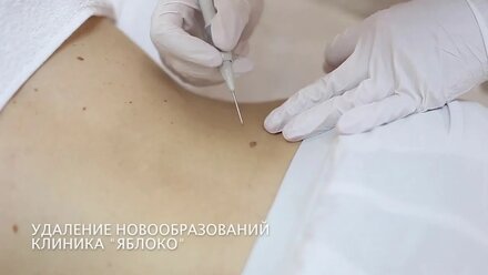 удаление новообразований