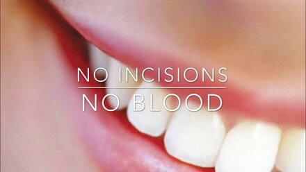Immediate load, dental implant costs, medical tourism: info@stanevko.by ,