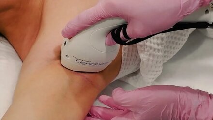 Лазерная эпиляция на аппарате Light Sheer Duet