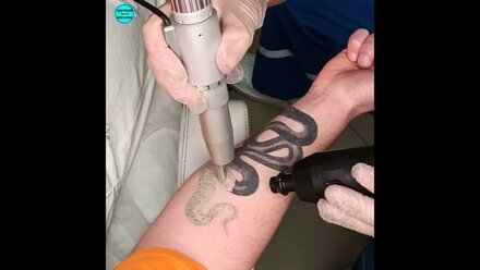 Удаление татуировки лазером в Воронеже