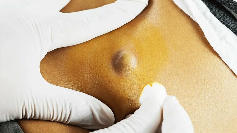 Жировики на теле, на лице: причины | Как избавиться от жировика (липомы ...