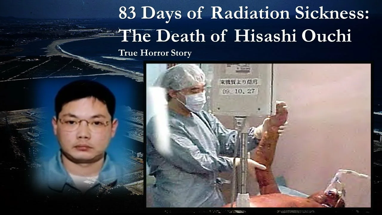 83 Days of Radiation Sickness: The Death of Hisashi Ouchi | True Horror  Story