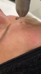 Мезотерапия без инъекций при помощи аппарата Dermadrop! #косметология #мезотерапия #молодость