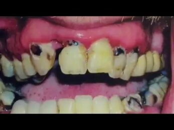 Базальная имплантация в Минске. Стоматолог Дмитрий Станевко.