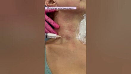 Мезотерапия области шеи #мезотерапия #мезотерапияшеи #косметология #косметологиямосква #косметолог