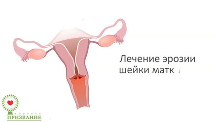Эрозия шейки матки: лечение "щадящим" способом | Самара