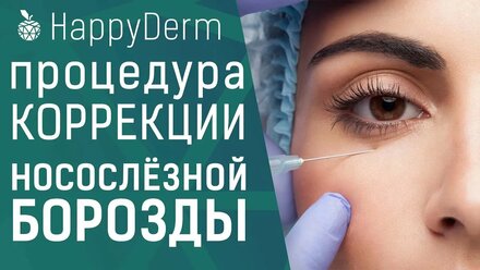 Процедура коррекция носослёзной борозды. Как убрать мешки под глазами без операции.
