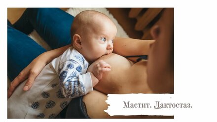 Лактостаз. Мастит.