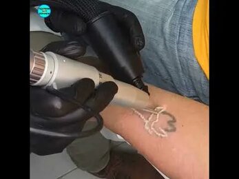 Профессиональное удаление татуировки