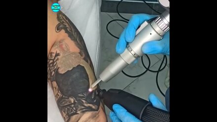 Лазерное удаление тату