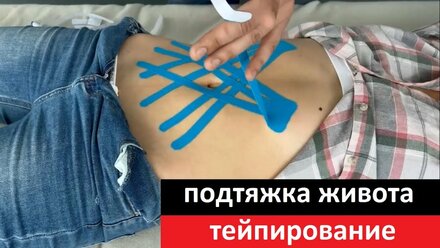 Подтяжка живота, тейпирование