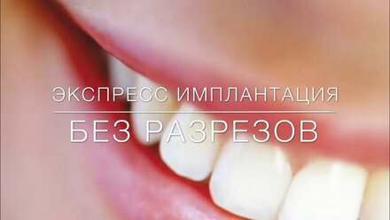 Одноэтапная базальная имплантация зубов в Беларуси