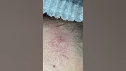 Удаление новообразований в клинике Laserplanet.