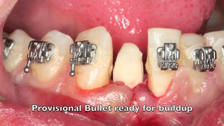 Dental Implant Surgery NobelActive 3 0 mm