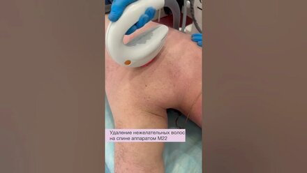 Удаление нежелательных волос на аппарате М22