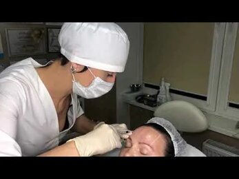 Ботулотерапия Full Face