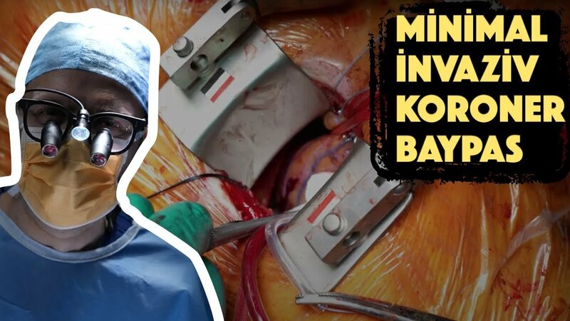 Minimal İnvaziv Koroner Baypas Ameliyatı Nasıl Yapılıyor? (Küçük Kesi ...