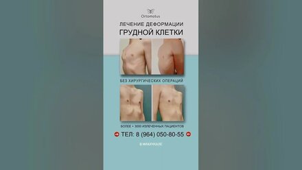 Лечение воронкообразной и килевидной деформации грудной клетки. Тел: 8 (964) 050-80-55