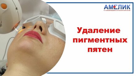 УДАЛЕНИЕ ПИГМЕНТНЫХ ПЯТЕН Йошкар-Ола
