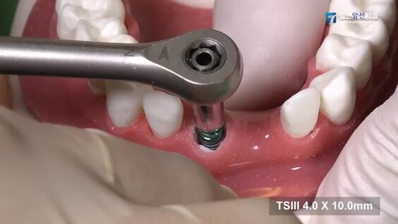 Установка Osstem имплантата — Видео от Osstem Implant