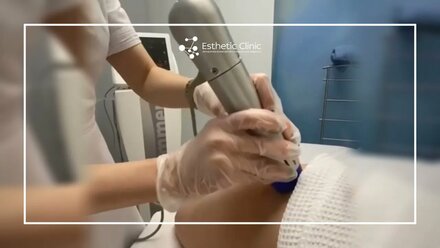 Ударно-волновая терапия Z-Wave в Esthetic Clinic