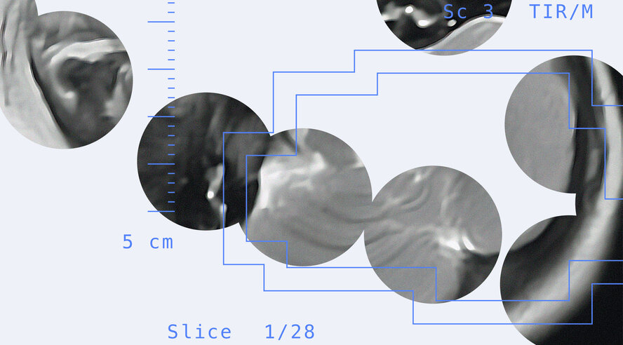 Open-Source AI Tool by Yandex Detects Signs of Infant Cerebral Palsy With Over 90% Accuracy