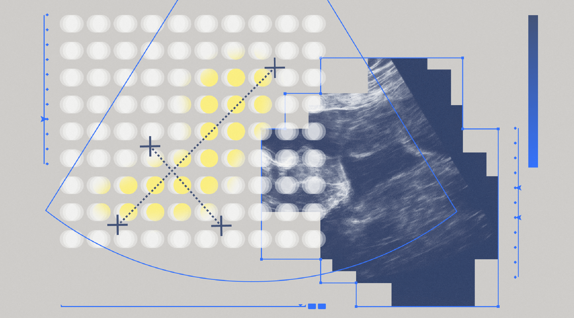 Новая нейросеть Яндекса, НМИЦ Кулакова и фонда «Спина бифида» поможет врачам выявлять редкую патологию на ранних сроках беременности