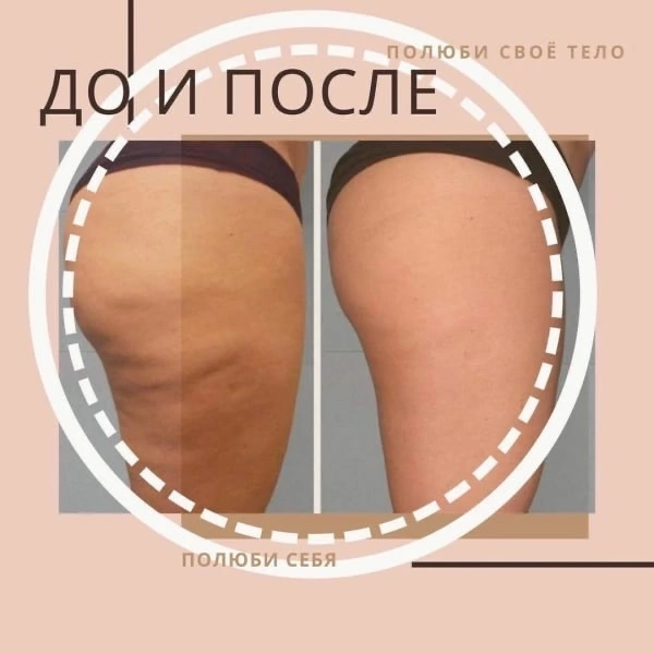 мезороллер от целлюлита до и после, эндосфера целлюлит, липолитики целлюлит до после, до и после антицеллюлитного массажа, целлюлит на бедрах