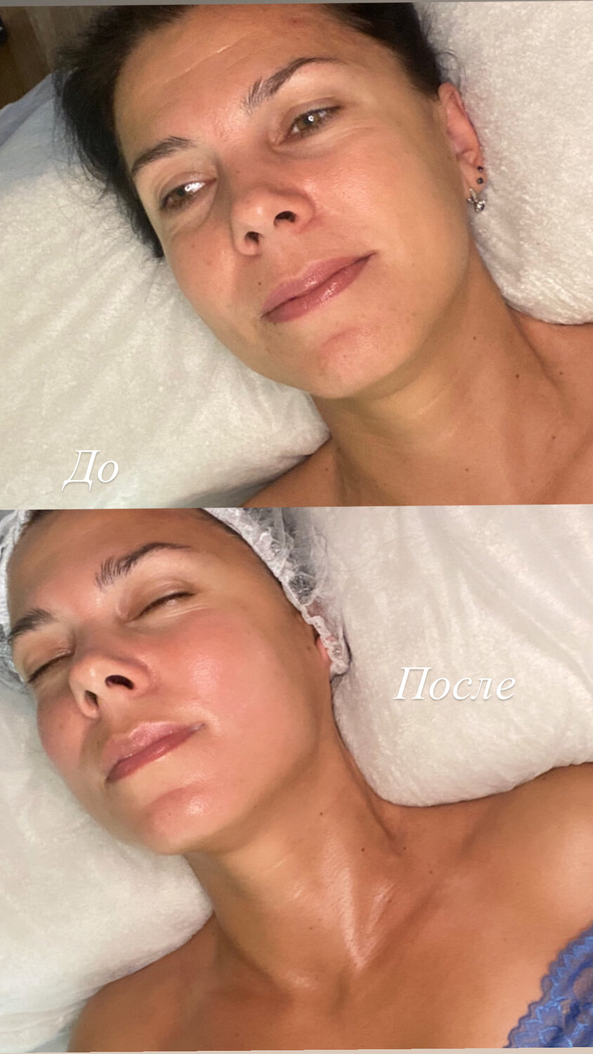 до и после массажа лица, пилинг, скульптурно-буккальный массаж лица до и после, косметолог чистка лица, пилинг лица