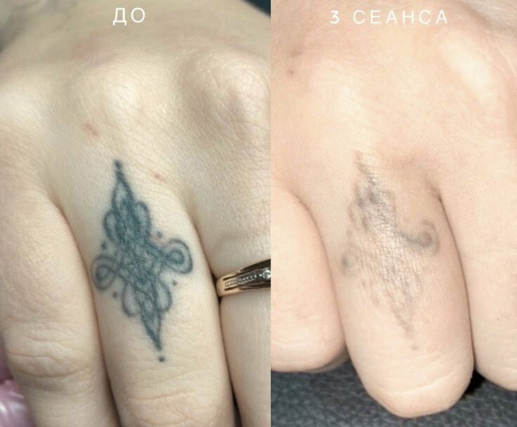 удаление татуировок лазером, удаление тату лазером, выведение тату лазером, удаление цветного тату лазером, после удаления тату лазером
