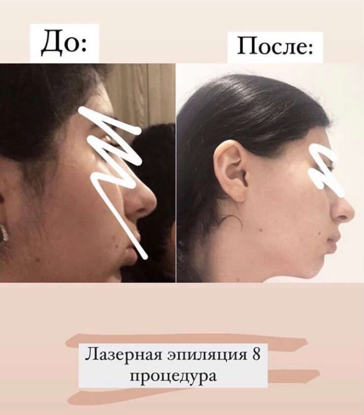 лазерная эпиляция лица, лазерная эпиляция, эпиляция лица, пластика лица, после