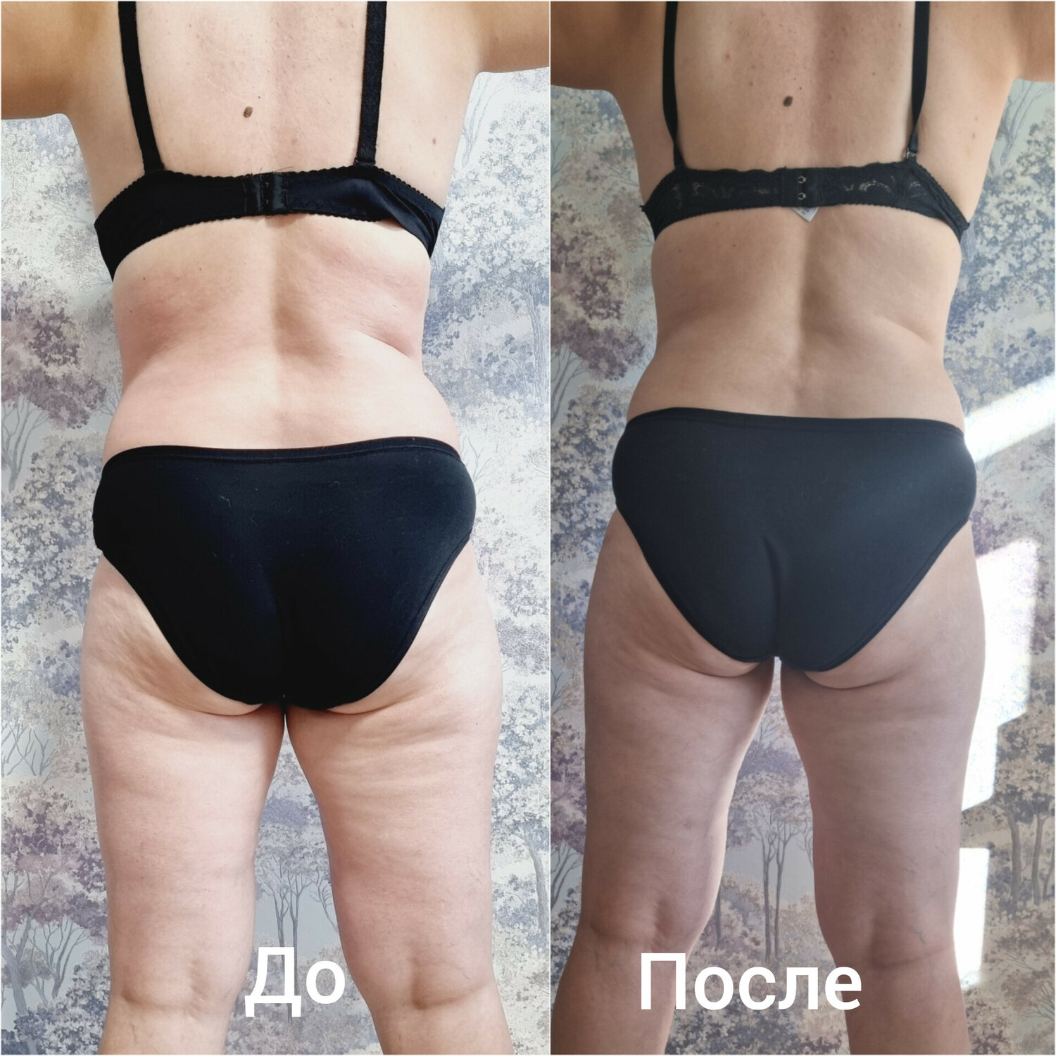 часть тела, после, антицеллюлитный массаж до и после 10 сеансов, коррекция тела, ручная липосакция