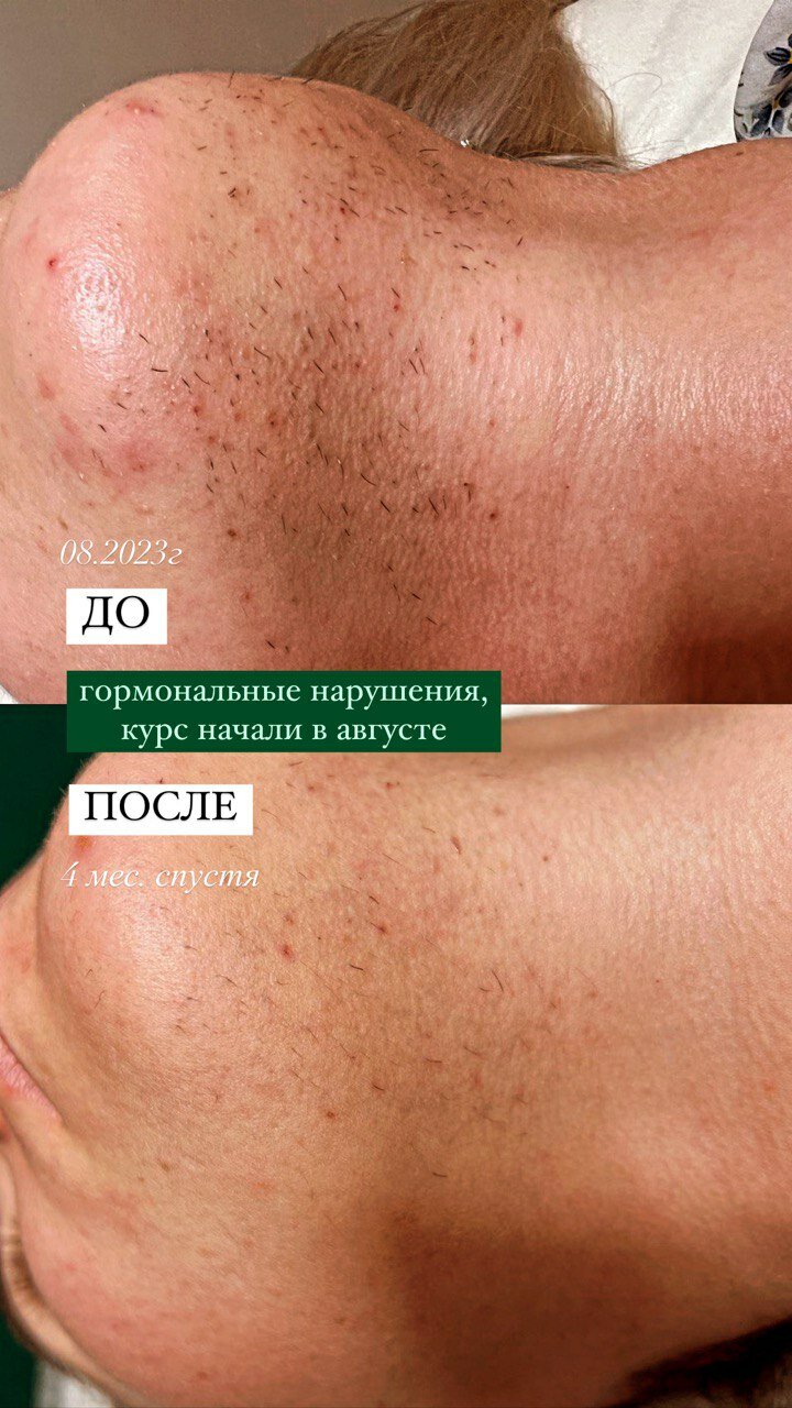 пигментация после эпиляции, после, пилинг, чистка лица, лечение акне