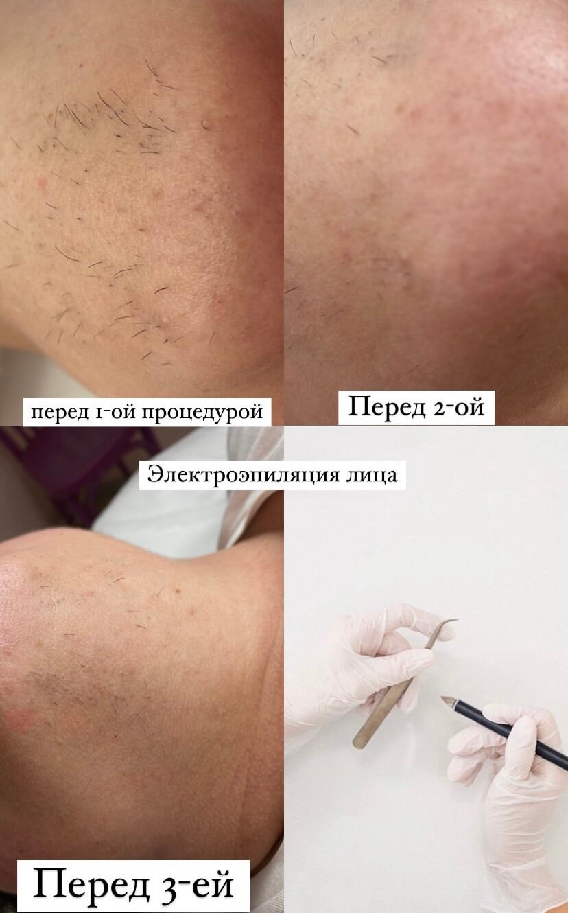 электроэпиляция лицо, электроэпиляция, результат после 1 лазерной эпиляции, электроэпиляция в москве, после лазерной эпиляции