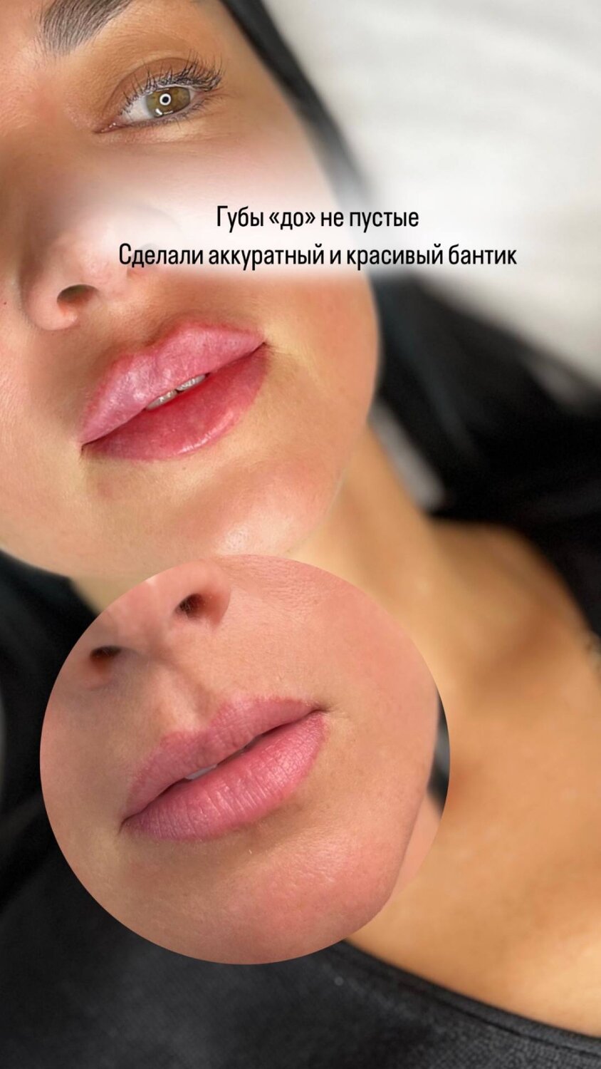 техника увеличения губ, губы увеличение, техника увеличения губ филлерами, после увеличения губ, увеличенные губы