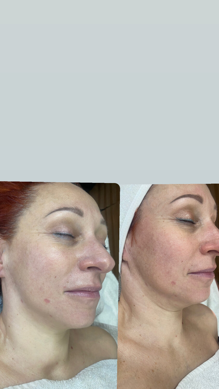 эффект би би глоу, микроигольчатый rf лифтинг, микроигольчатый rf лифтинг лица, bb glow процедура для лица, пилинг